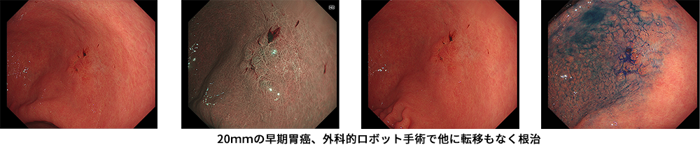 胃癌の発見