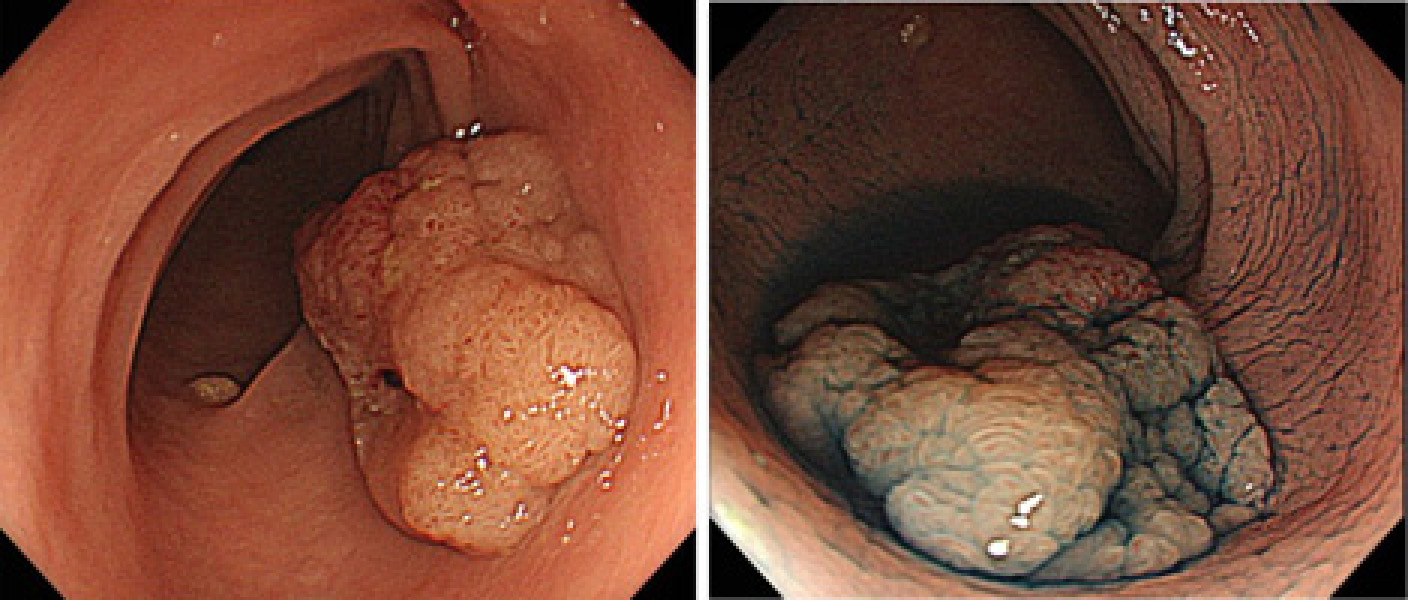 S状結腸の大きさ30mmの病変。一部に癌の存在を疑う腫瘍性病変。