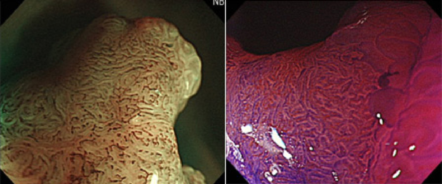 NBIや色素、ピオクタニン染色などを施し、100倍に拡大した内視鏡写真